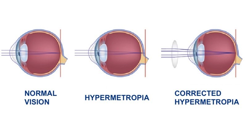 Difference Between Myopia and Hypermetropia